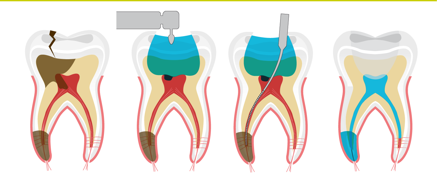 endodoncia sevilla